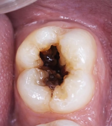 Molar com cárie profunda antes do tratamento