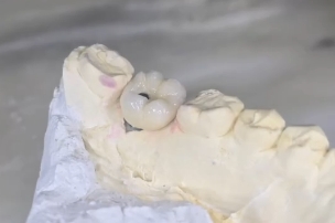Modelo de gesso com prótese fixa sobre os dentes posteriores