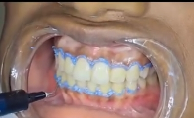 Barreira gengival aplicada antes do branqueamento dentário