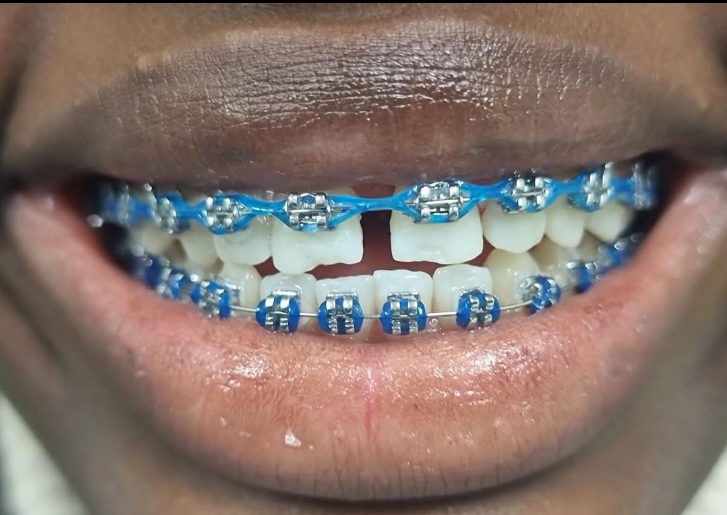 Sorriso com aparelho ortodôntico fixo, elásticos azuis nas duas arcadas