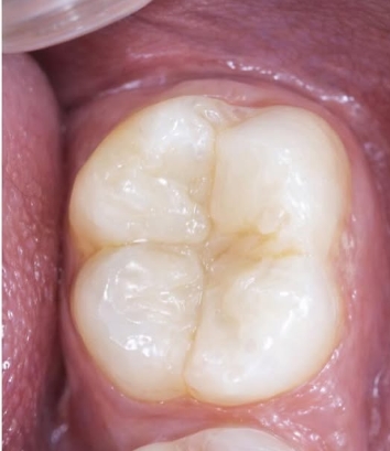 O mesmo molar depois do tratamento, com a cavidade restaurada